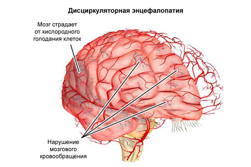 Дисциркуляторная энцефалопатия