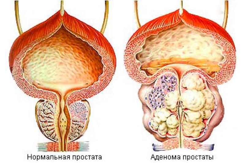 Аденома предстательной железы