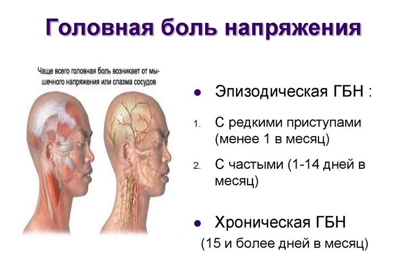 Головная боль напряжения