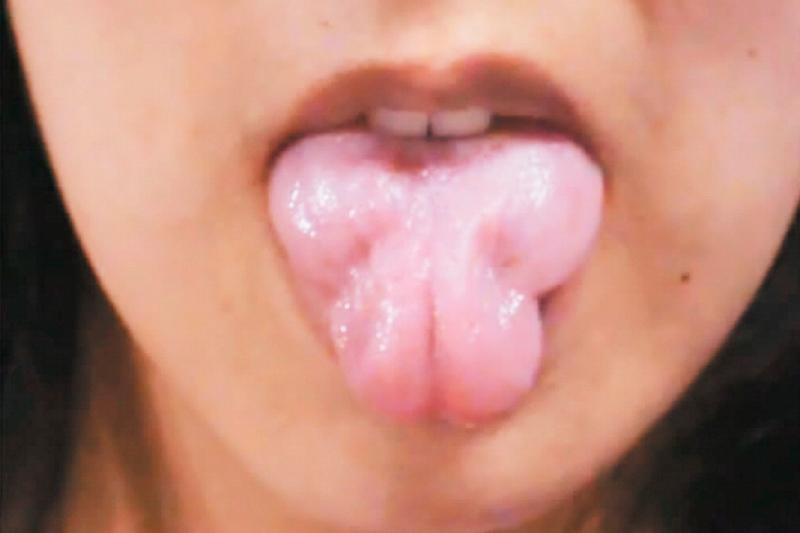 Миотония Миотония