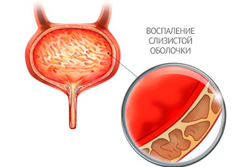 Острый цистит Острый цистит