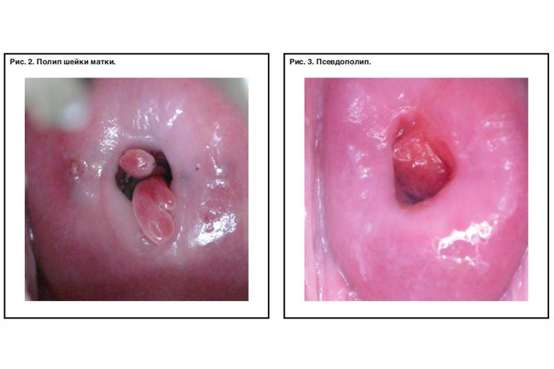 Доброкачественные опухоли влагалища