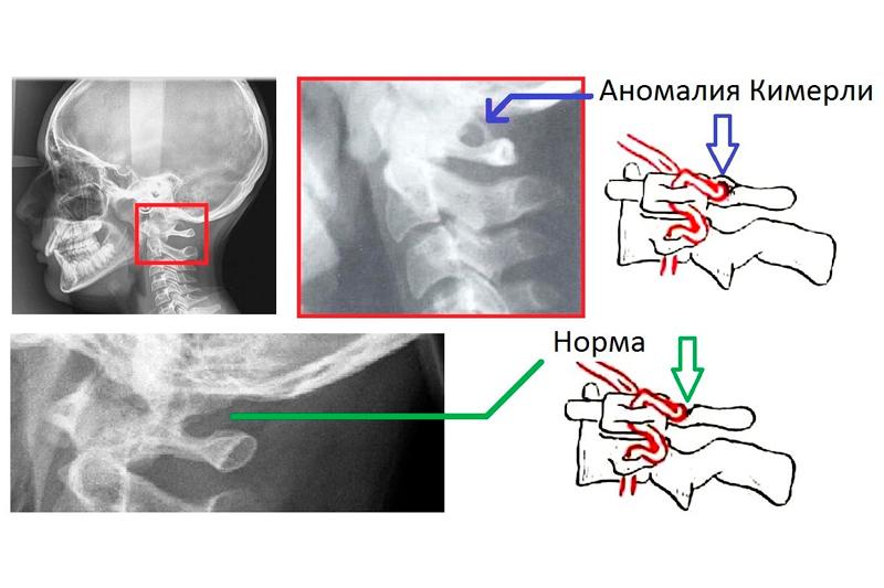 Аномалия Кимерли Аномалия Кимерли