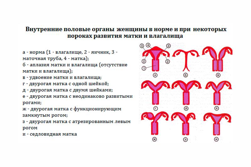 Пороки развития влагалища