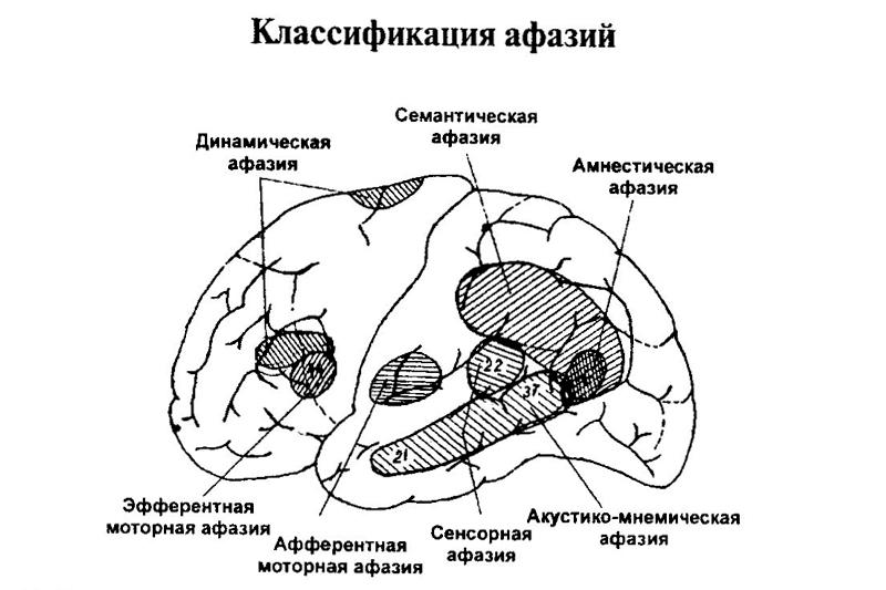 Афазия Афазия
