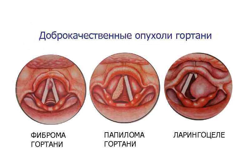 Доброкачественные опухоли гортани