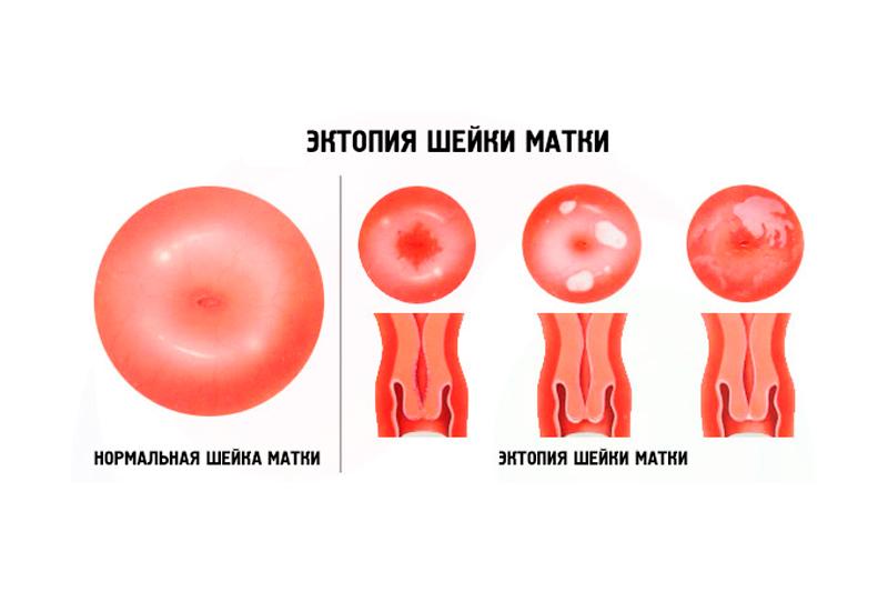 Эктопия шейки матки Эктопия шейки матки