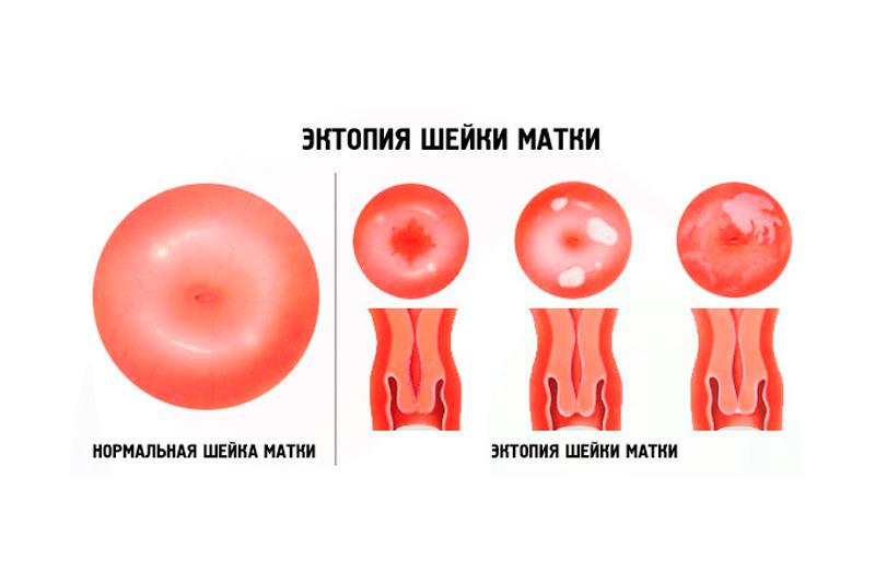 Эктопия шейки матки