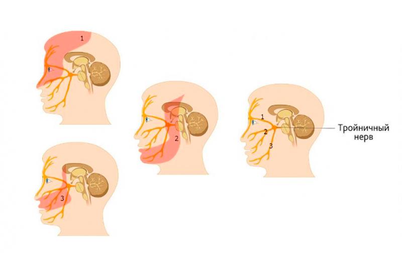 Невралгия тройничного нерва