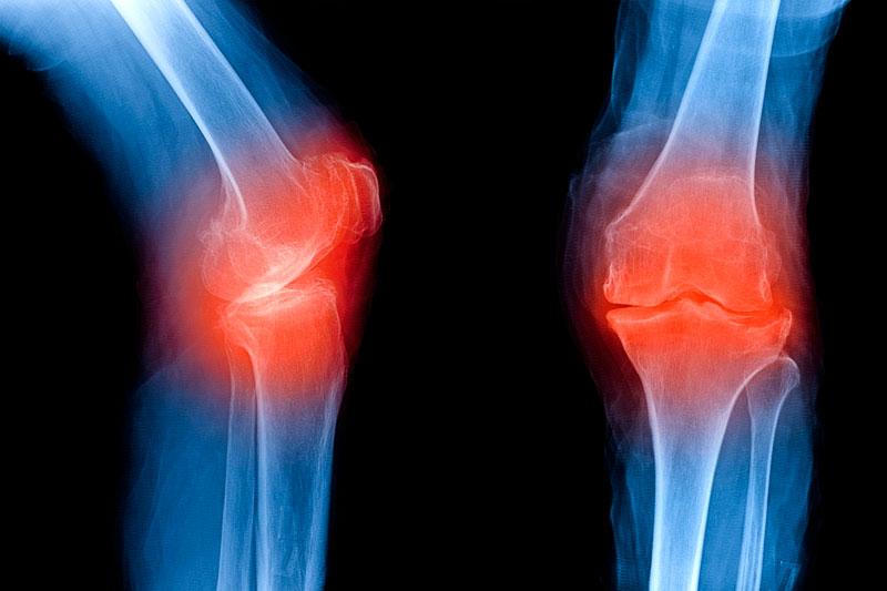 Рентген коленного сустава