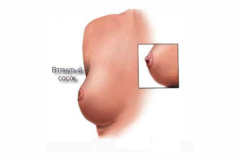 Втянутые соски Втянутые соски