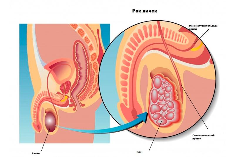 Рак яичек