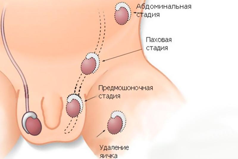 Крипторхизм Крипторхизм