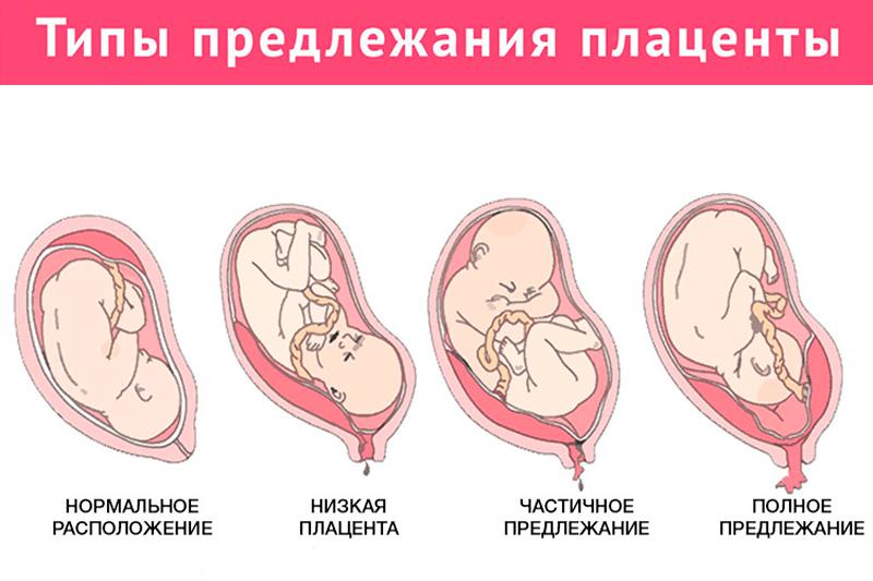 Предлежание плаценты при беременности