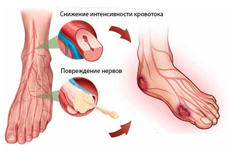 Диабетическая нейропатия Диабетическая нейропатия
