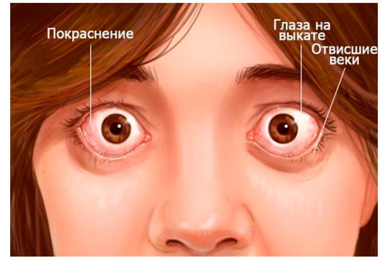 Эндокринная офтальмопатия Эндокринная офтальмопатия