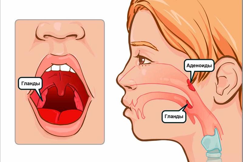Аденоиды