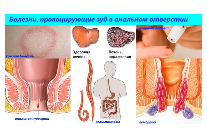 Анальный зуд