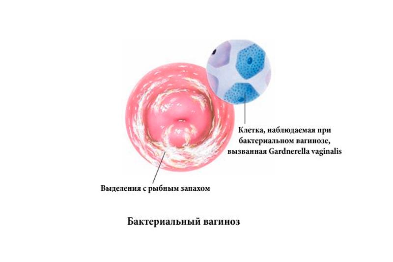 Бактериальный вагиноз