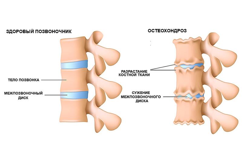 Остеохондроз позвоночника
