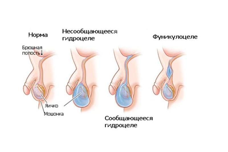 Фуникулоцеле Фуникулоцеле
