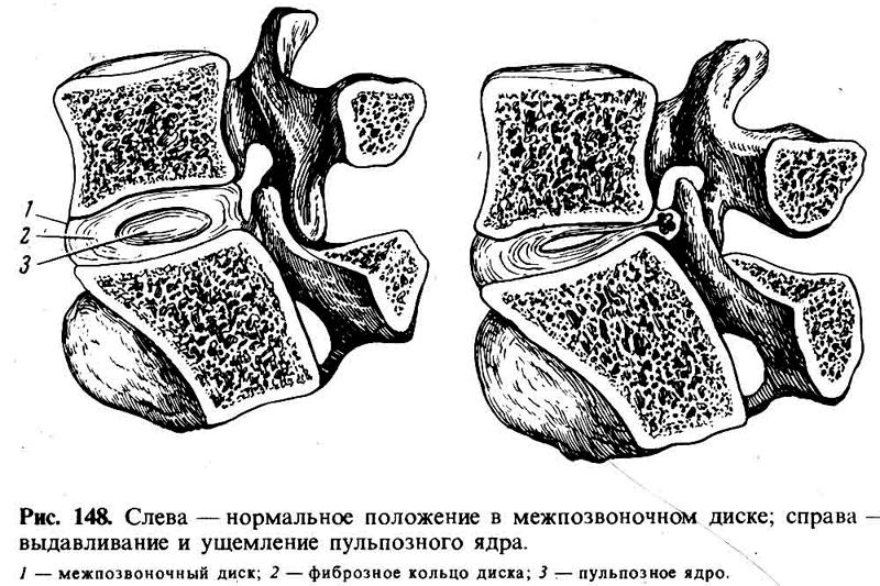 Дискогенная миелопатия