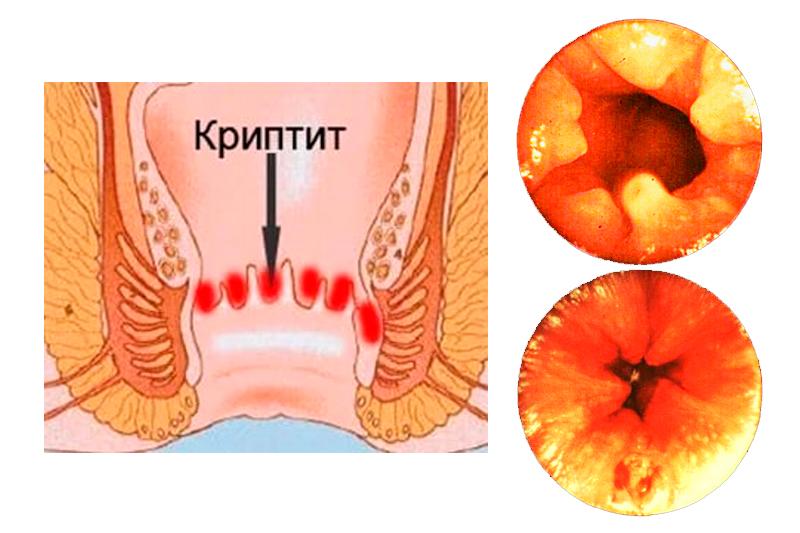 Криптит