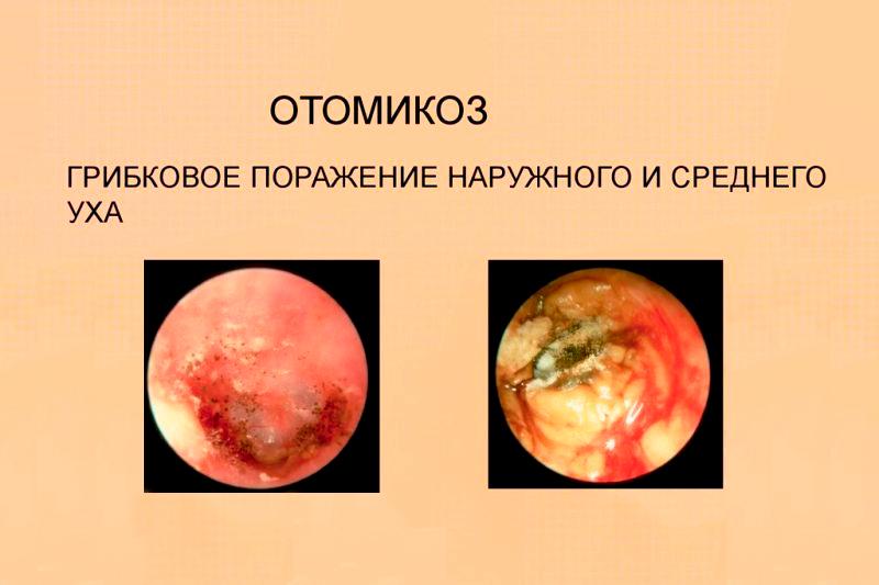 Отомикоз Отомикоз