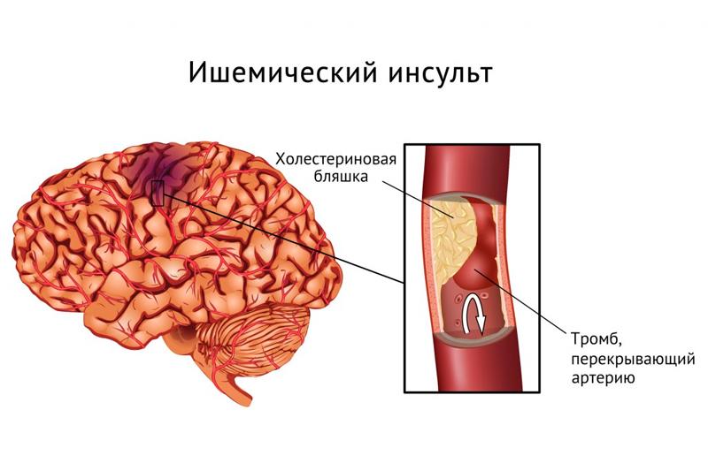 Ишемический инсульт Ишемический инсульт