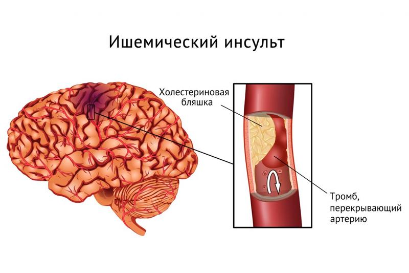 Ишемический инсульт