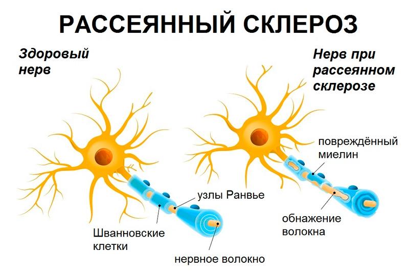 Рассеянный склероз