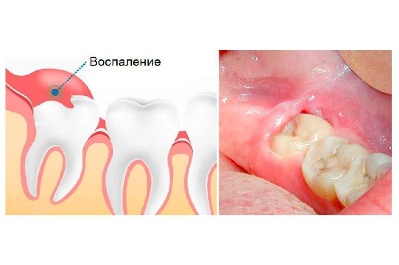 Перикоронарит