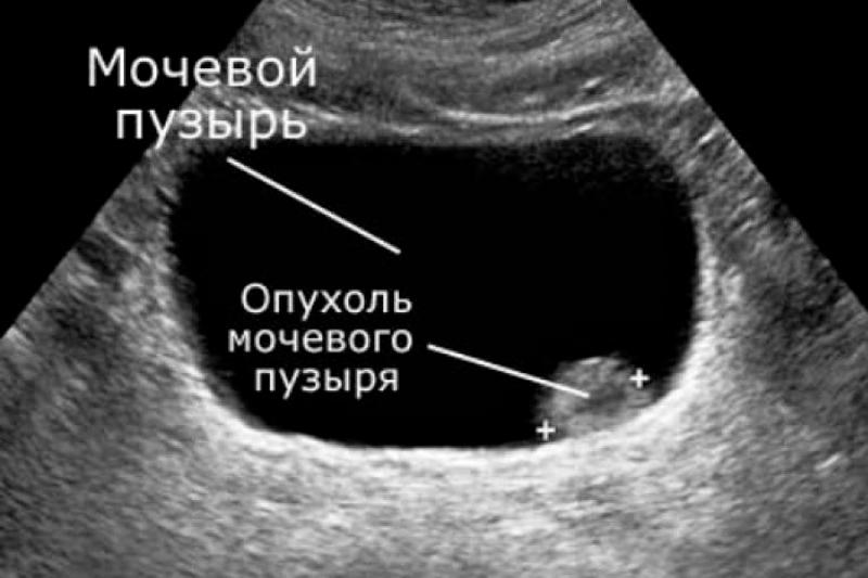 Доброкачественная опухоль мочевого пузыря