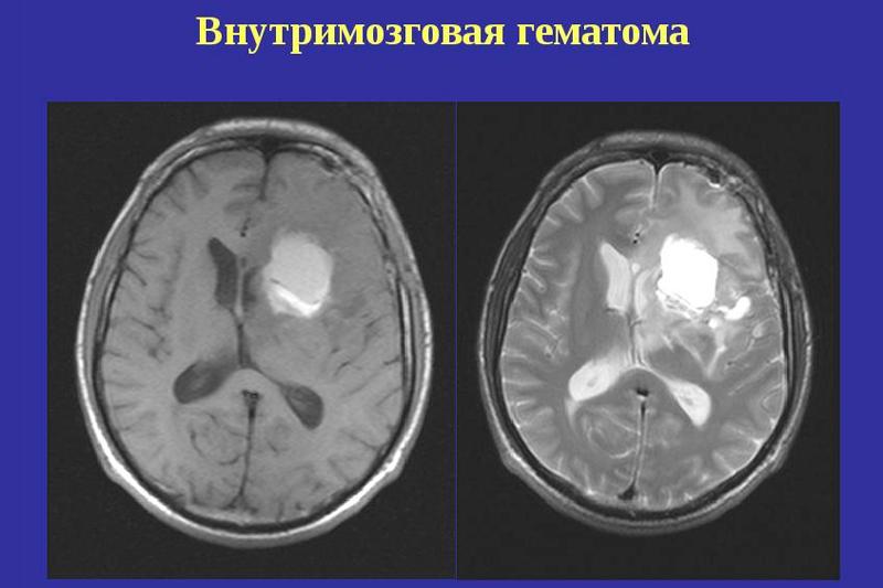 Внутримозговая гематома