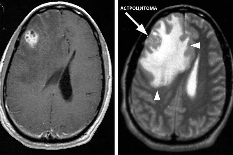 Астроцитома головного мозга