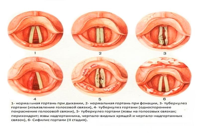 Туберкулез гортани Туберкулез гортани
