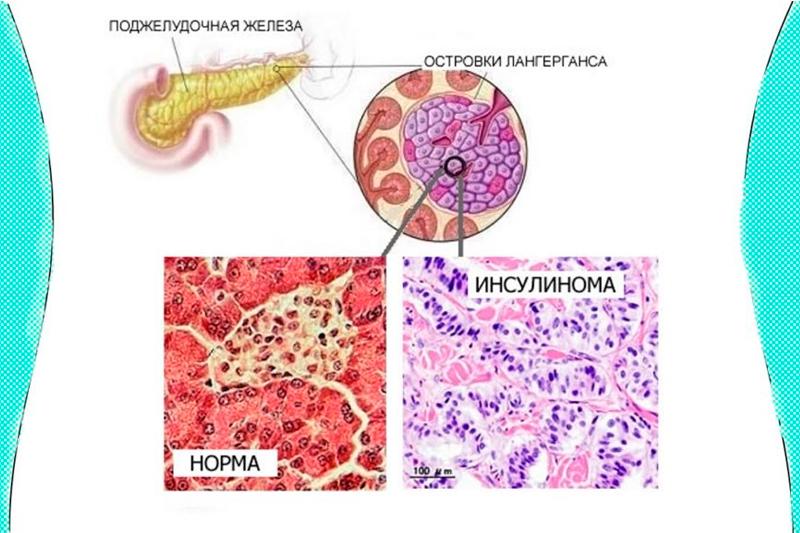 Инсулинома Инсулинома