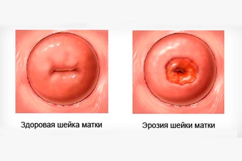 Эрозия шейки матки Эрозия шейки матки