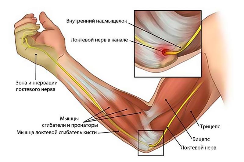 Неврит