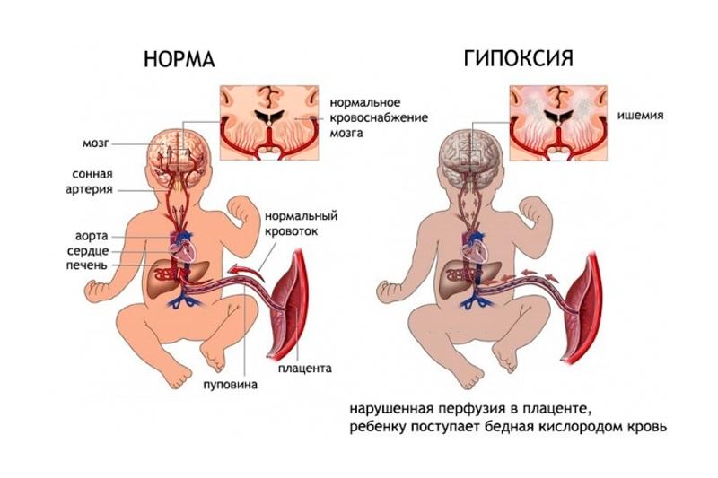 Гипоксия плода