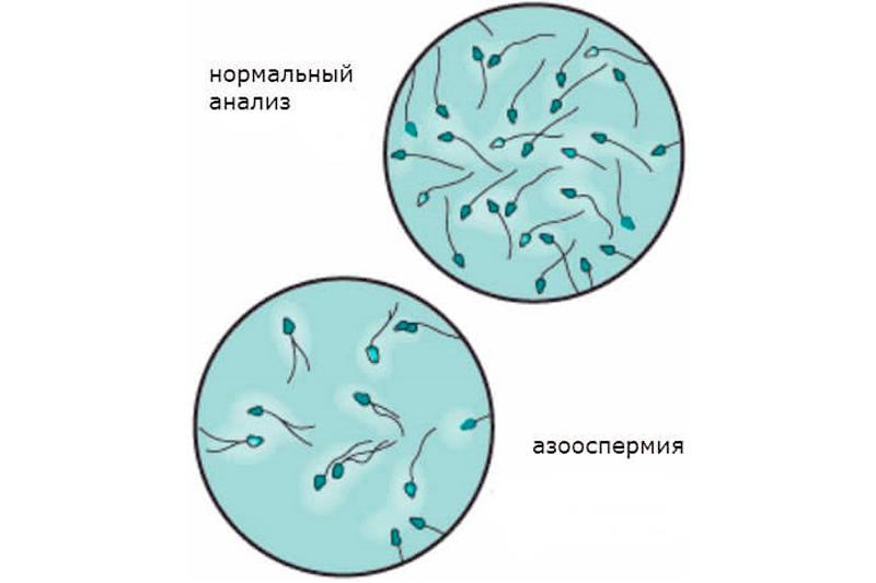 Азооспермия Азооспермия