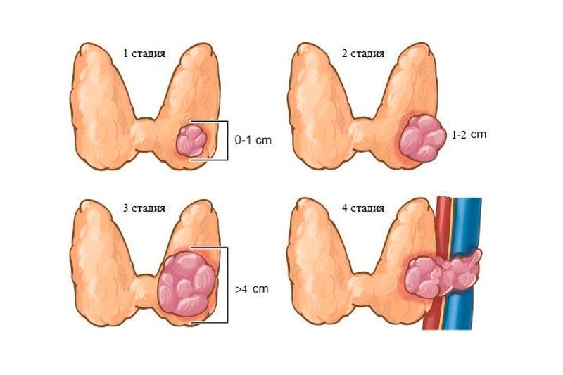 На что влияет рак щитовидной железы thumbnail