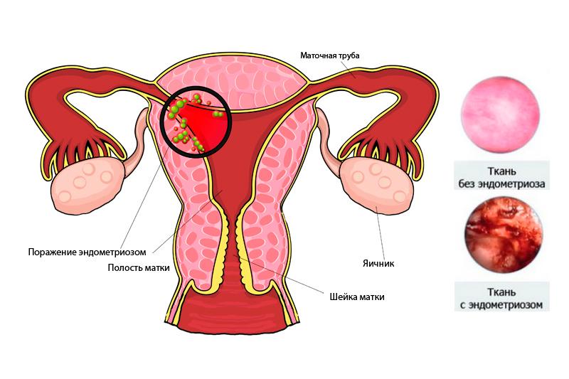 Эндометриоз