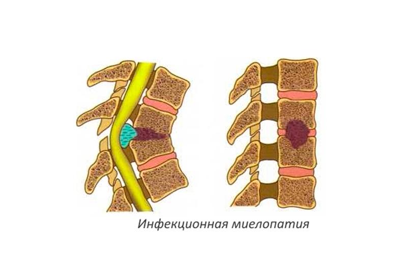 Инфекционная миелопатия