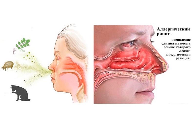 Аллергический ринит