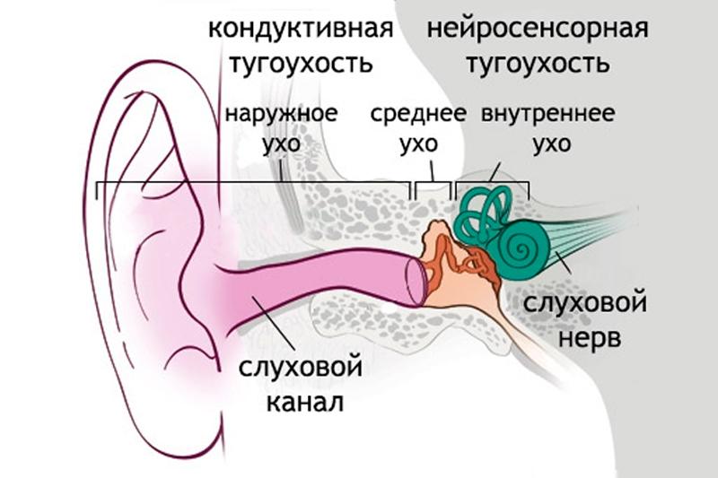 Тугоухость