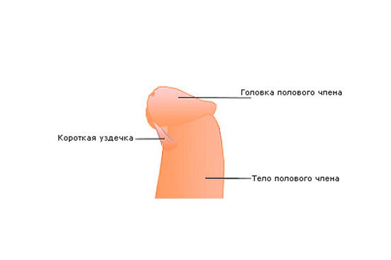Короткая уздечка крайней плоти Короткая уздечка крайней плоти