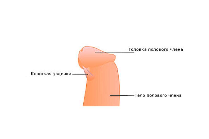 Короткая уздечка крайней плоти