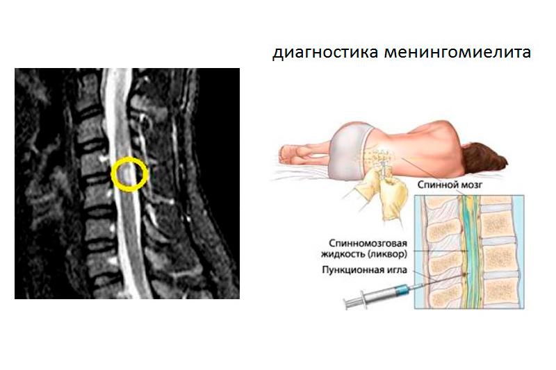 Менингомиелит