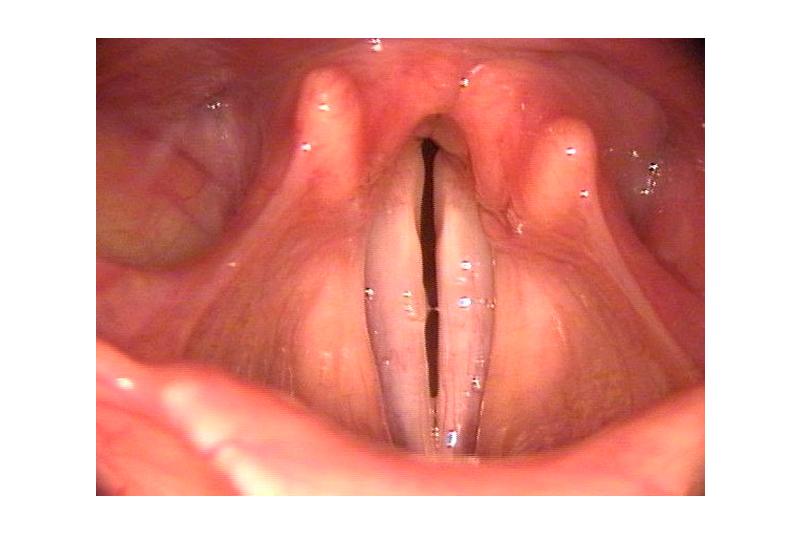 Нейропатический парез гортани